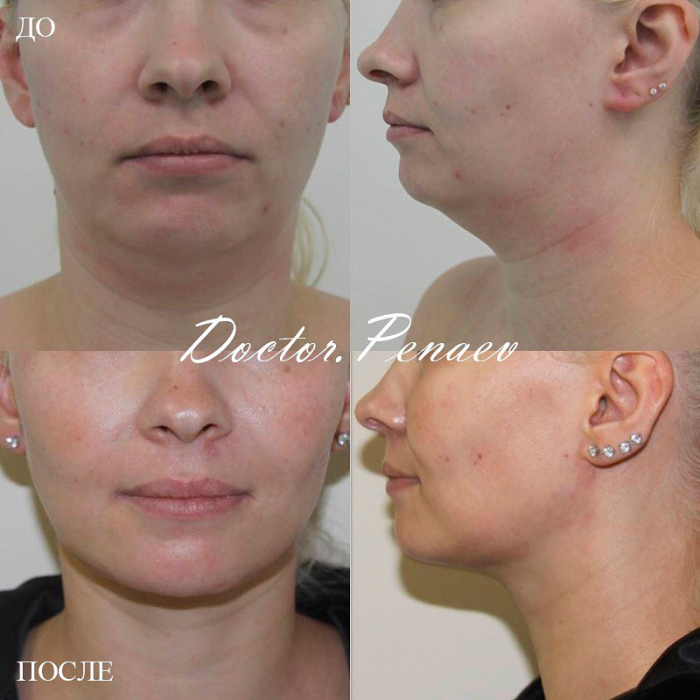 Пациентка до и после ультразвукового липомоделирования подбородочной области