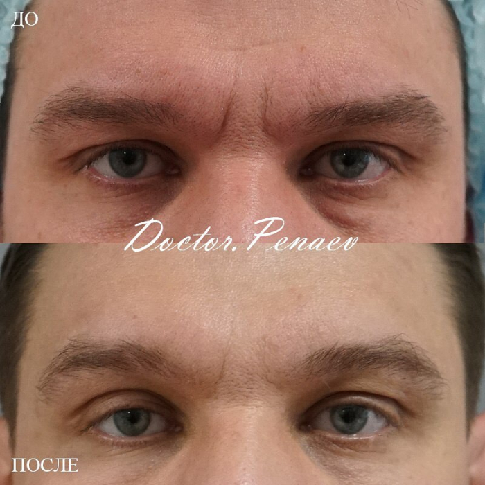 Пациент доктора Арслана Пенаева до и после процедуры Вечный Ботокс