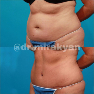 Пациентка до и после липосакции у доктора Гукаса Миракяна