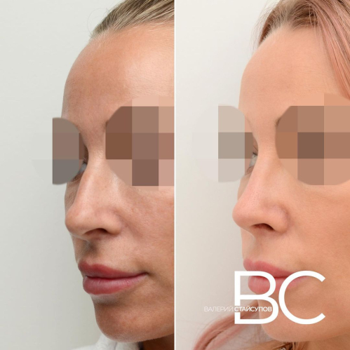 Фото пациентки до и после закрытой ринопластики у Валерия Стайсупова