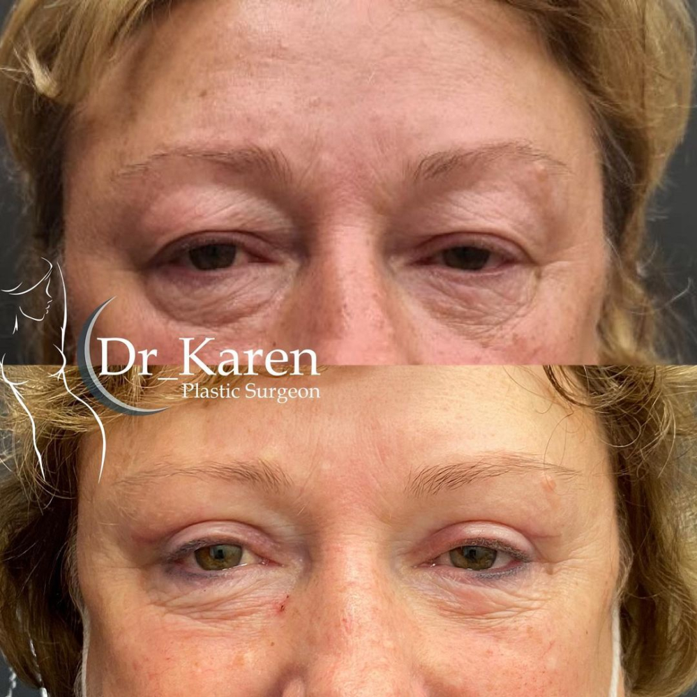 Пациентка доктора Карена Пайтяна до и после блефаропластики