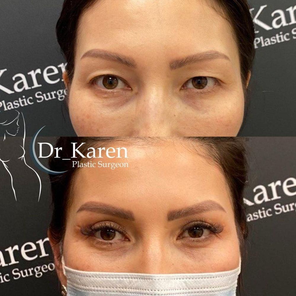 Пациентка доктора Карена Пайтяна до и после азиатской блефаропластики
