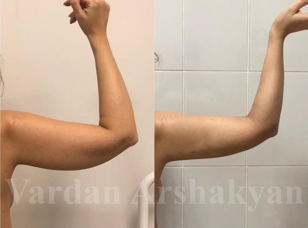 Снимок пациентки доктора Вардана Аршакяна до и после подтяжки рук BrakhioTite