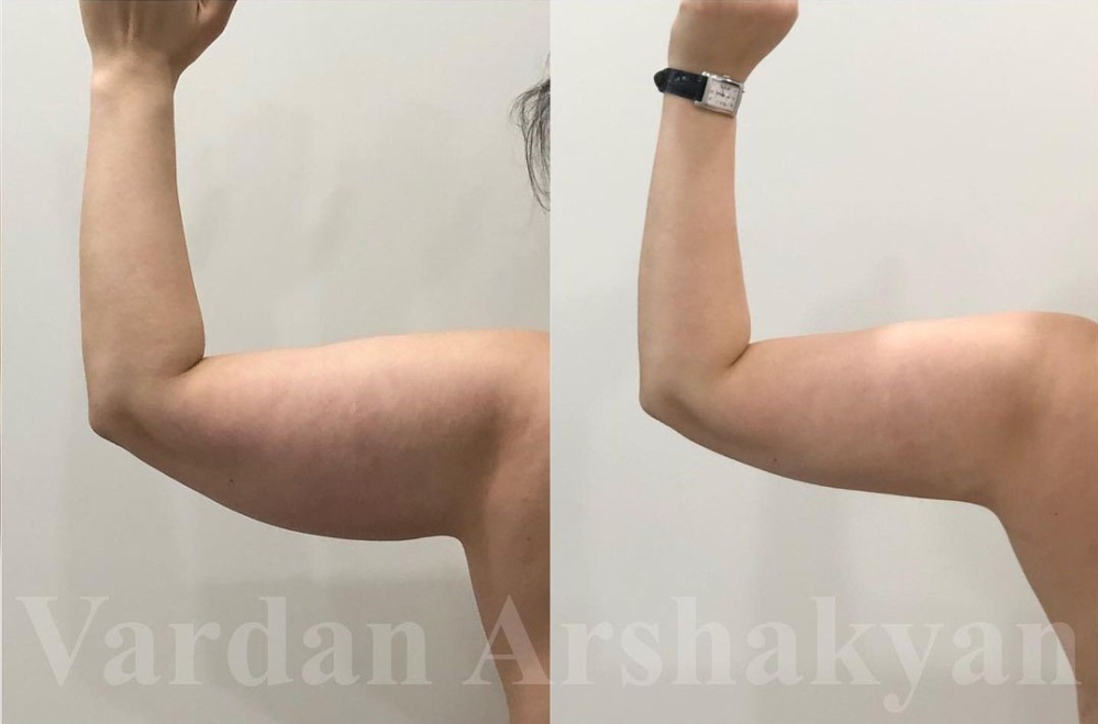 Фото пациентки доктора Вардана Аршакяна до и после подтяжки рук BrakhioTite