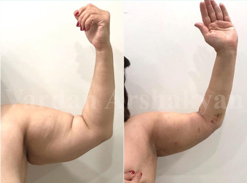 Пациентка доктора Вардана Аршакяна до и после радиочастотной подтяжки рук