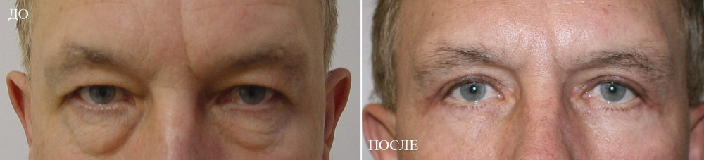 Пациент доктора Арслана Пенаева до и после мужской блефаропластики