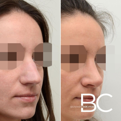 Фото пациентки до и после закрытой ринопластики у доктора Стайсупова