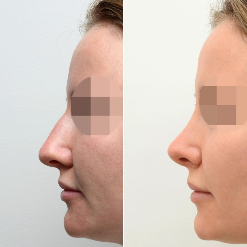 Фото пациентки до и после закрытой ринопластики у доктора Валерия Стайсупова