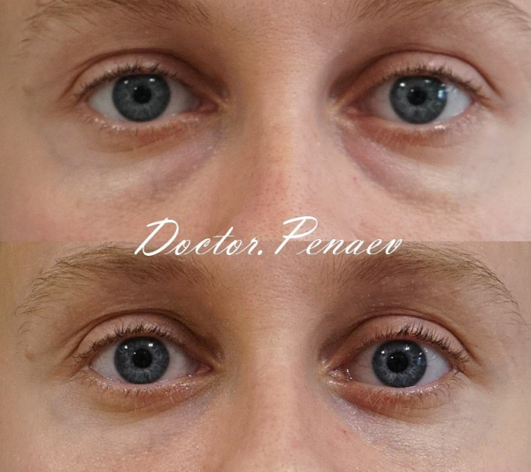 Блефаропластика трансконъюнктивально