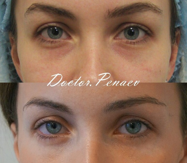 рансконъюнктивальная блефаропластика