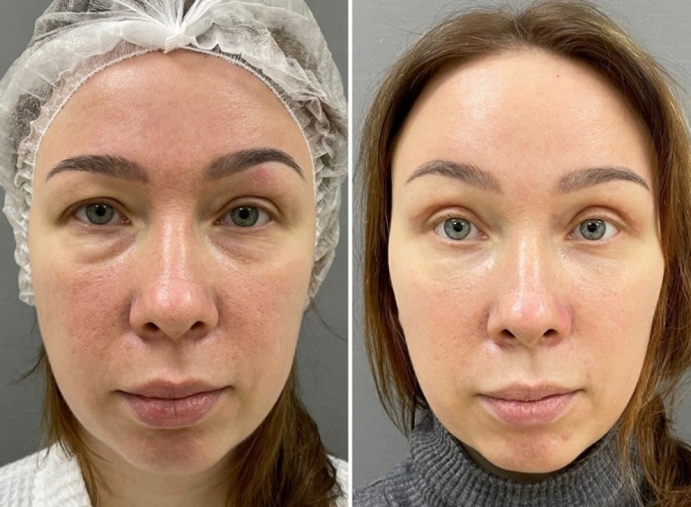 эндоскопическая периорбитопластика