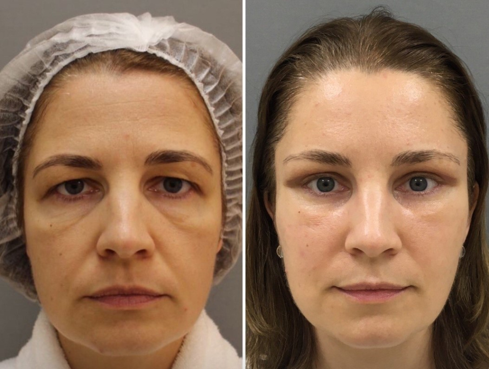 периорбитопластика Четверикова