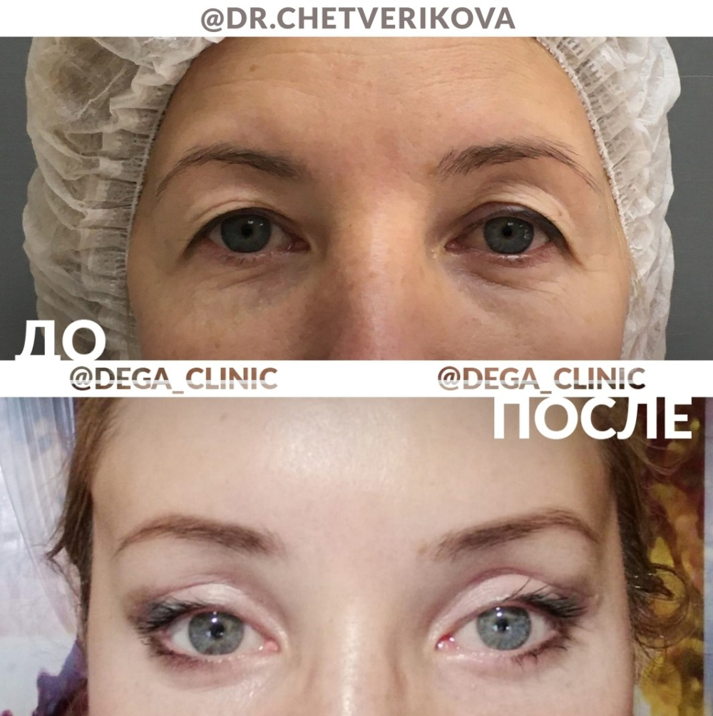 Периорбитопластика и блефаропластика Марина Четверикова