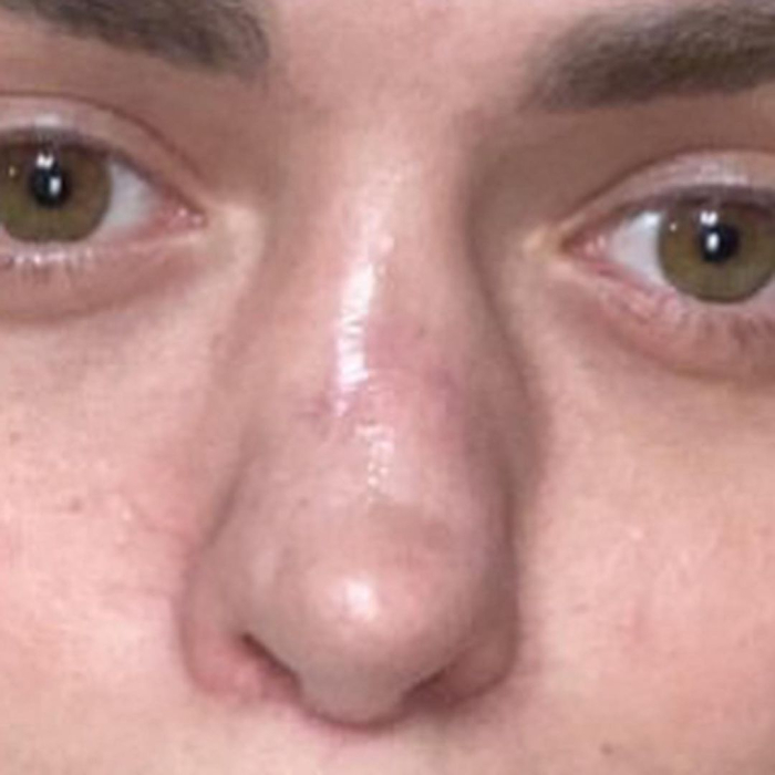 Анастасии Балинской испортили нос после ринопластики