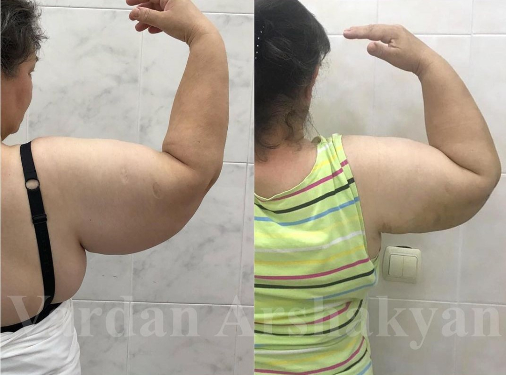 Пациентка доктора Вардана Аршакяна до и после подтяжки рук BrakhioTite