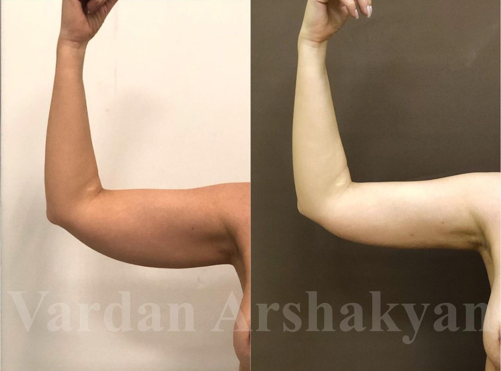 Пациентка доктора Вардана Аршакяна до и после радиочастотной пластики рук