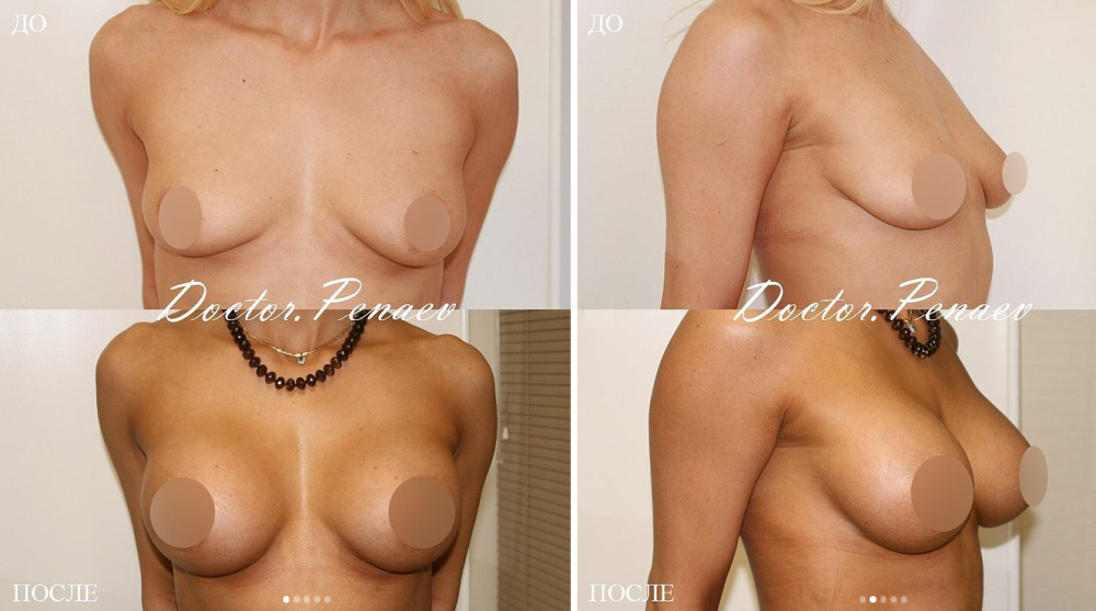 Пациентка доктора Арслана Пенаева до и после увеличения груди