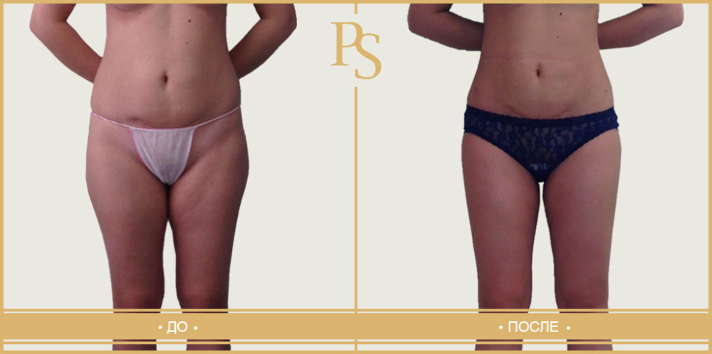 Пациентка доктора Светланы Пшонкиной до и после липосакции бедер