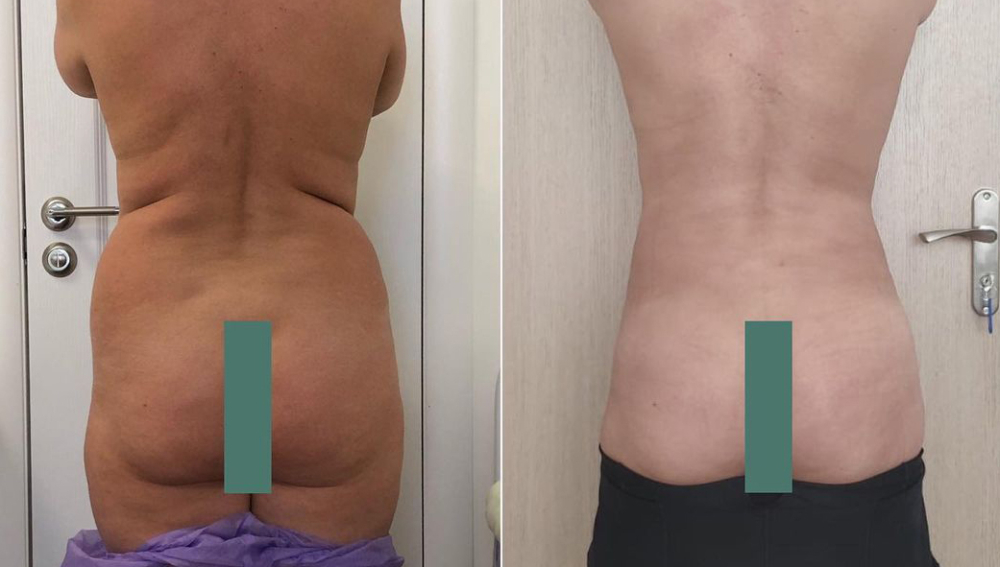 липосакция лучший хирург