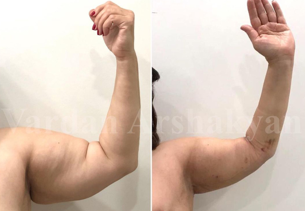 Брахиотайт брахиопластика