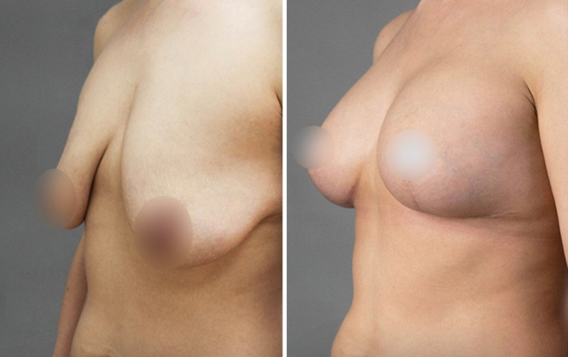 Пациентка доктора Четвериковой до и после подтяжки груди на имплантах