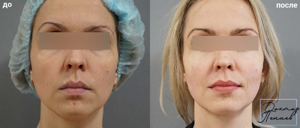 Пациентка доктора Арслана Пенаева до и после липофилинга лица