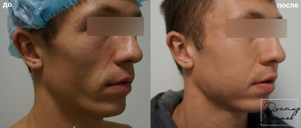 Пациент доктора Арслана Пенаева до и после липофилинга лица