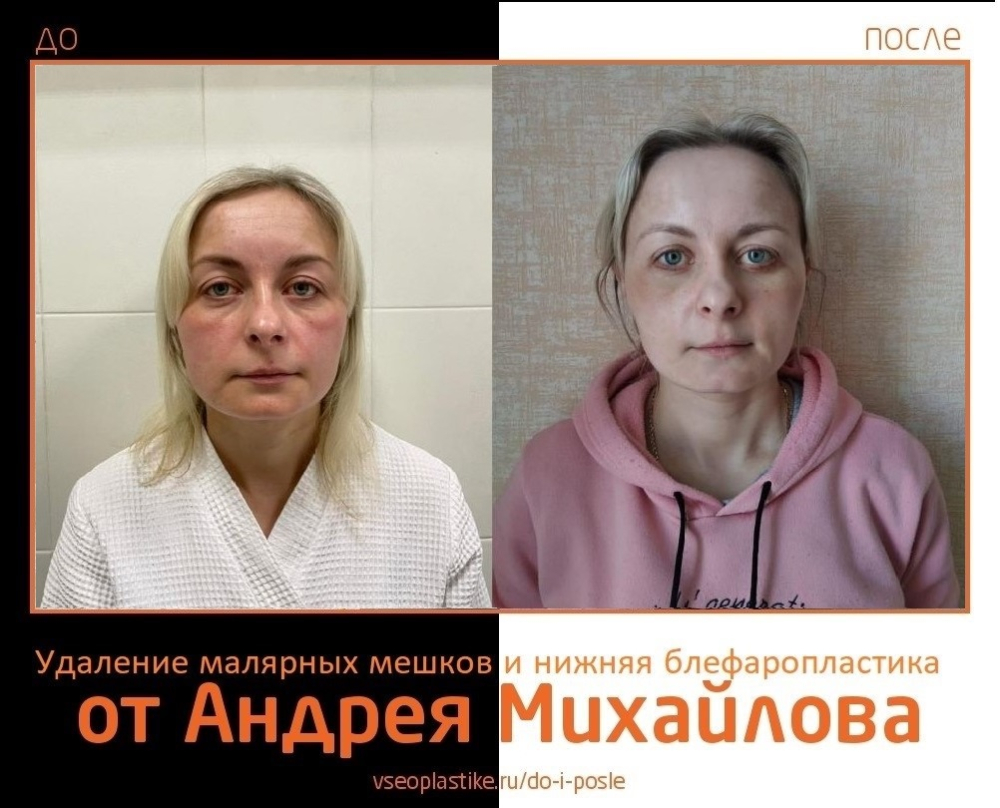 Андрей Михайлов. Фото до и после удаления малярных мешков и пластики век