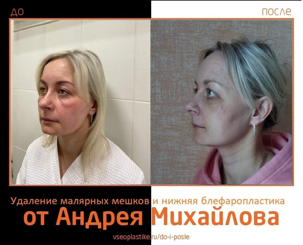 Фото до и после удаления малярных мешков и пластики век у доктора Андрея Михайлова