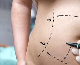 Как достигнуть и поддерживать оптимальные результаты абдоминопластики?