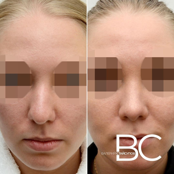 Пациентка Валерия Стайсупова до и после закрытой ринопластики