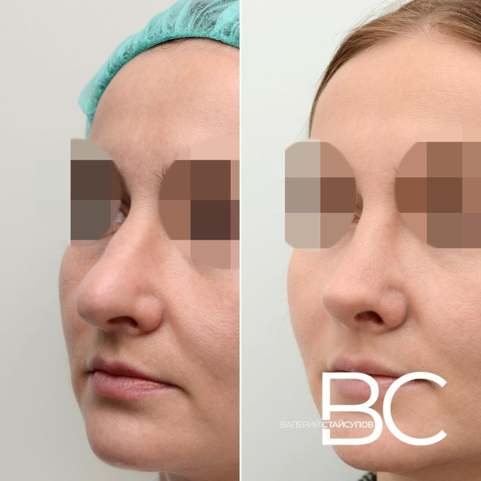 Пациентка Валерия Стайсупова до и после закрытой ринопластики