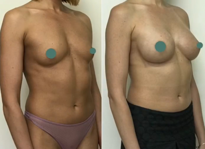 Natural Beauty увеличение груди Аршакян