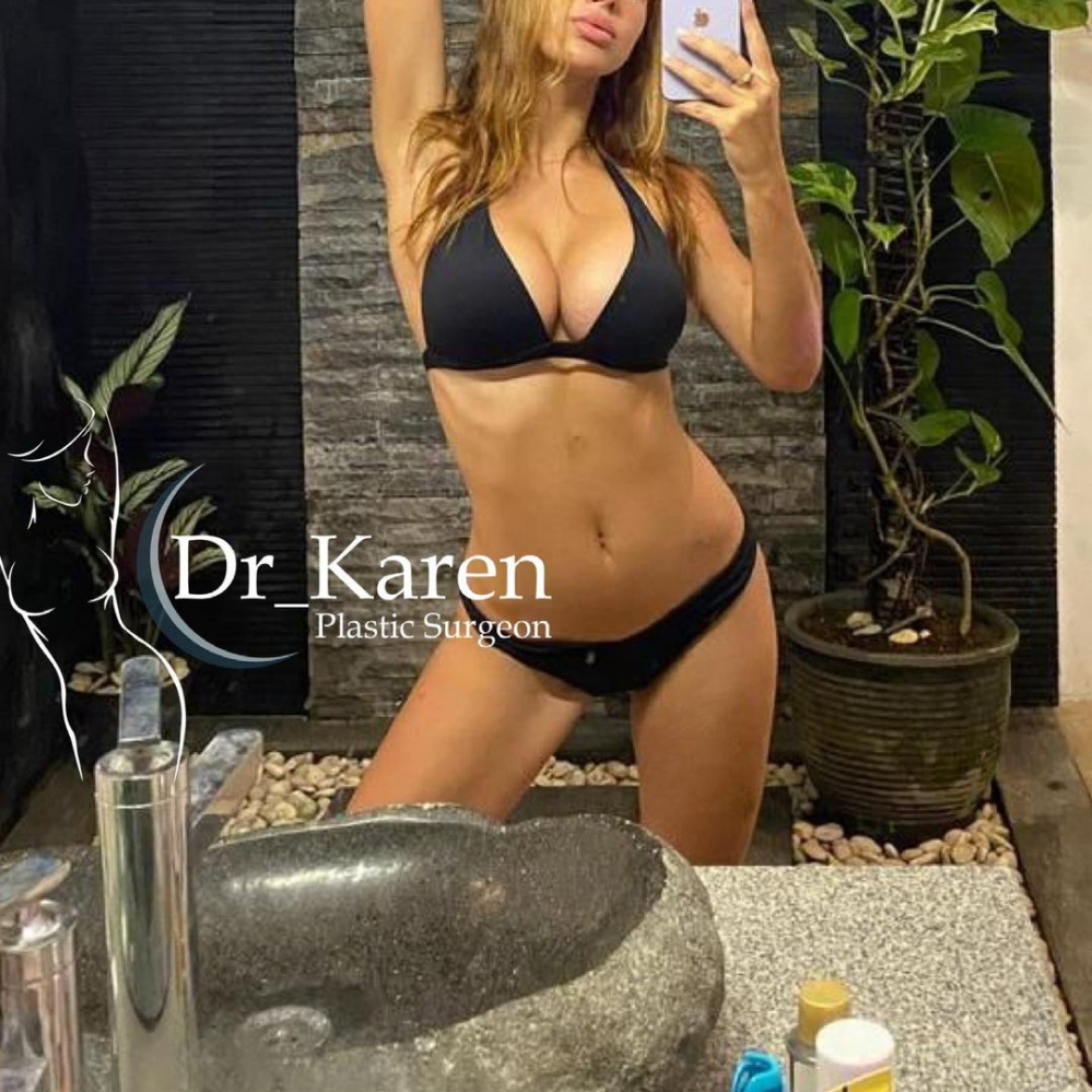 Пациентка доктора Пайтяна после увеличения груди.