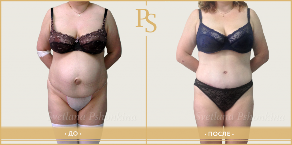 Пациентка пластического хирурга Светланы Пшонкиной до и после абдоминопластики и удаления грыжи