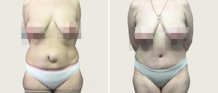 абдомино с удалением грыжи