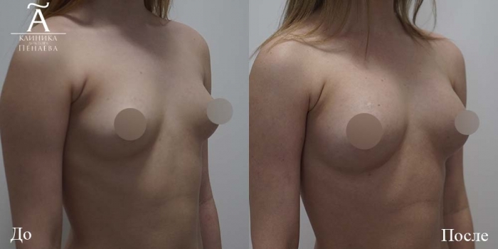 Пациентка доктора Арслана Пенаева до и после липофилинга груди