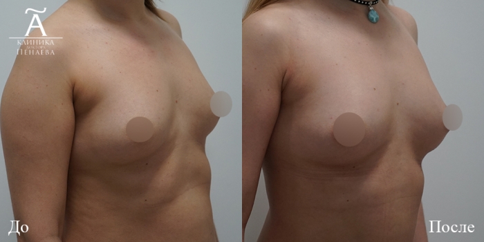 Пациентка доктора Арслана Пенаева до и после липофилинга груди