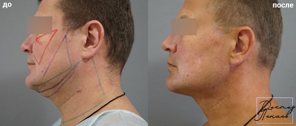 Пациент доктора Пенаева до и после мультитехнологичной пластики лица