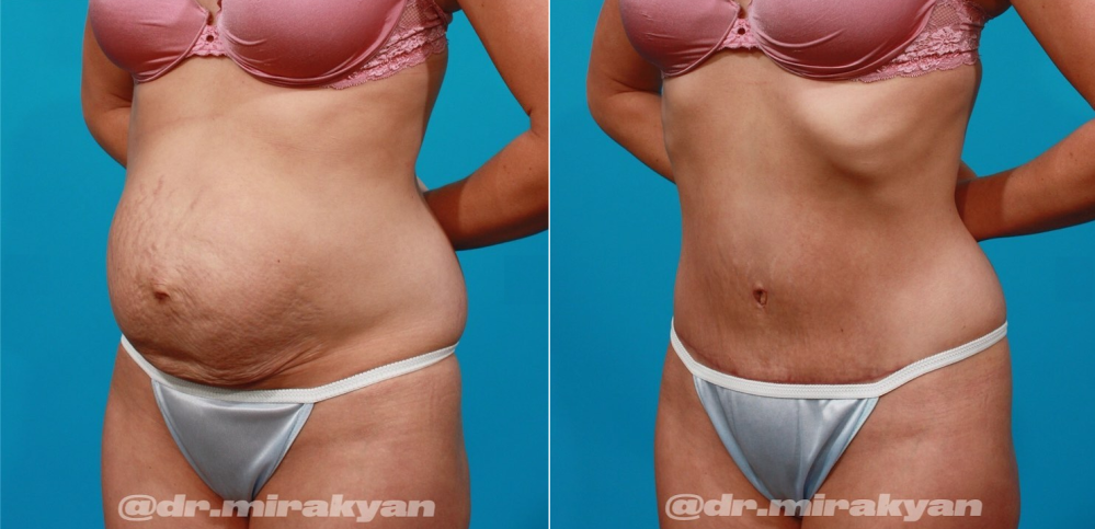 Пациентка доктора Гукаса Миракяна до и после абдоминопластики