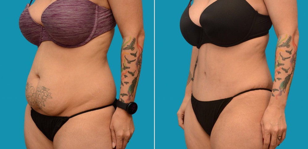 Пациентка доктора Гукаса Миракяна до и после абдоминопластики