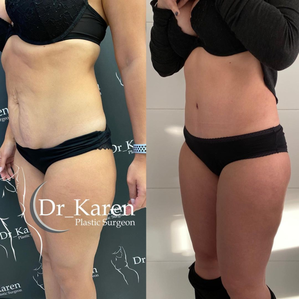 Пациентка пластического хирурга Карена Пайтяна до и после абдоминопластики, липосакции спины и зоны галифе