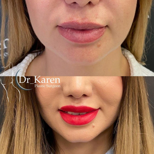 Пациентка пластического хирурга Карена Пайтяна до и после операции Булхорн