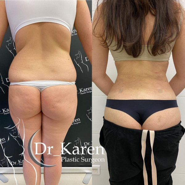 Пациентка пластического хирурга Карена Пайтяна до и после круговой липосакции