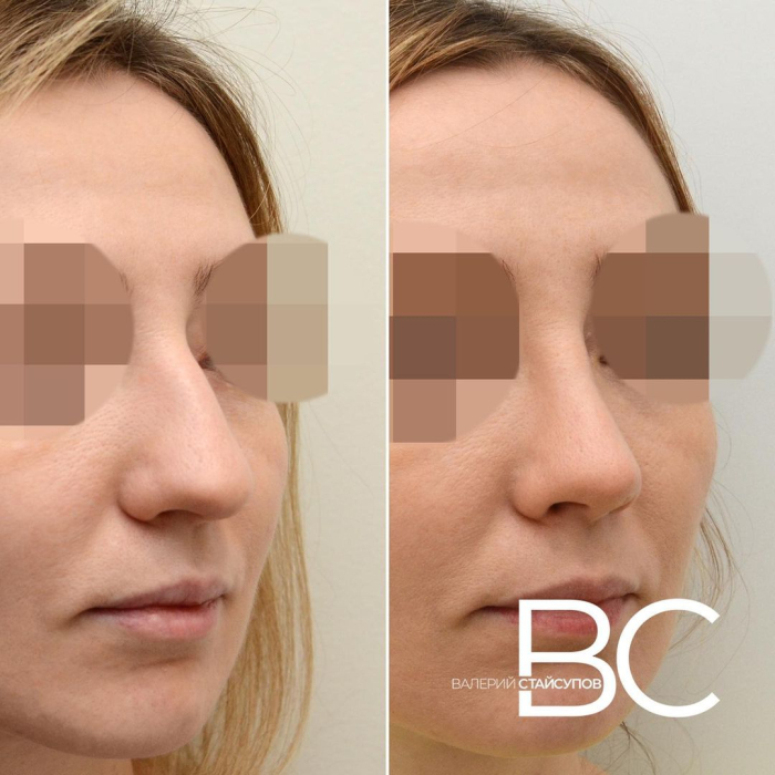 Пациентка Валерия Стайсупова до и после закрытой ринопластики