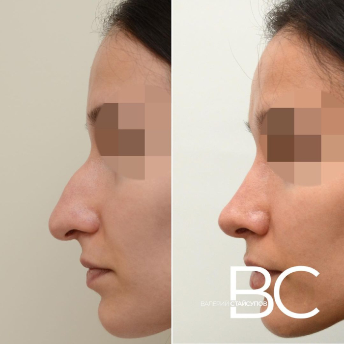 Пациентка Валерия Стайсупова до и после закрытой ринопластики