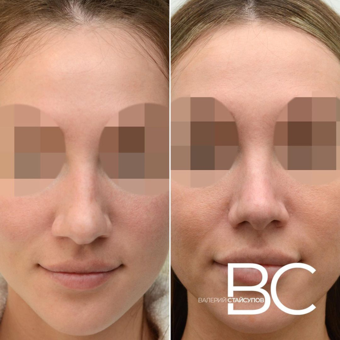 Пациентка доктора Стайсупова до и после риносептопластики