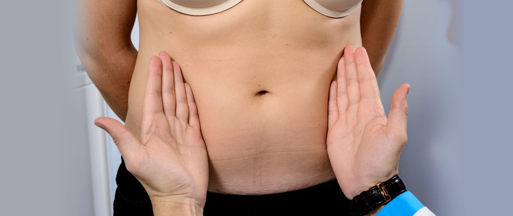 пупок после абдоминопластики