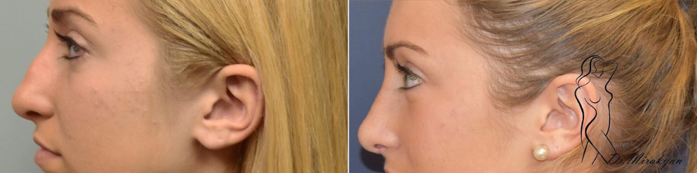 Гукас Миракян ринопластика до и после