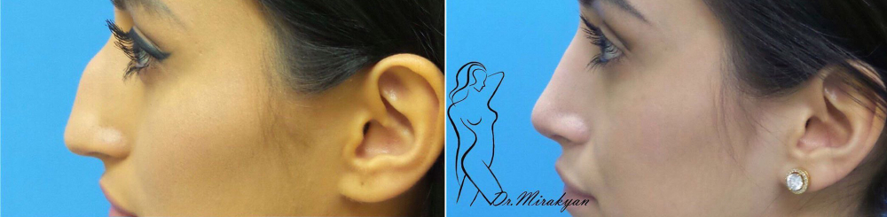 Пациентка Гукаса Миракяна до и после ринопластики